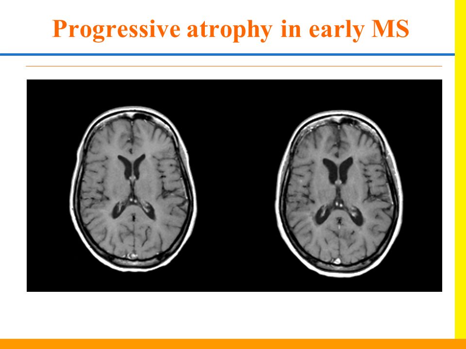 Progressive atrophy in early MS