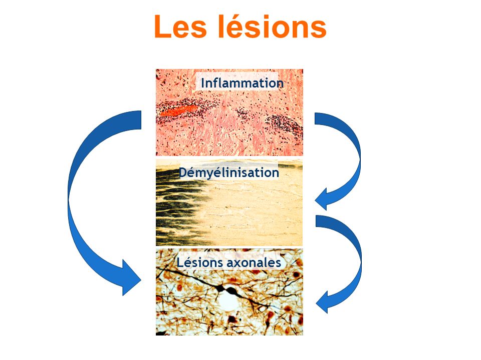 Les lésions Inflammation Démyélinisation Lésions axonales