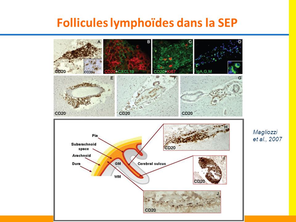 Follicules lymphoïdes dans la SEP