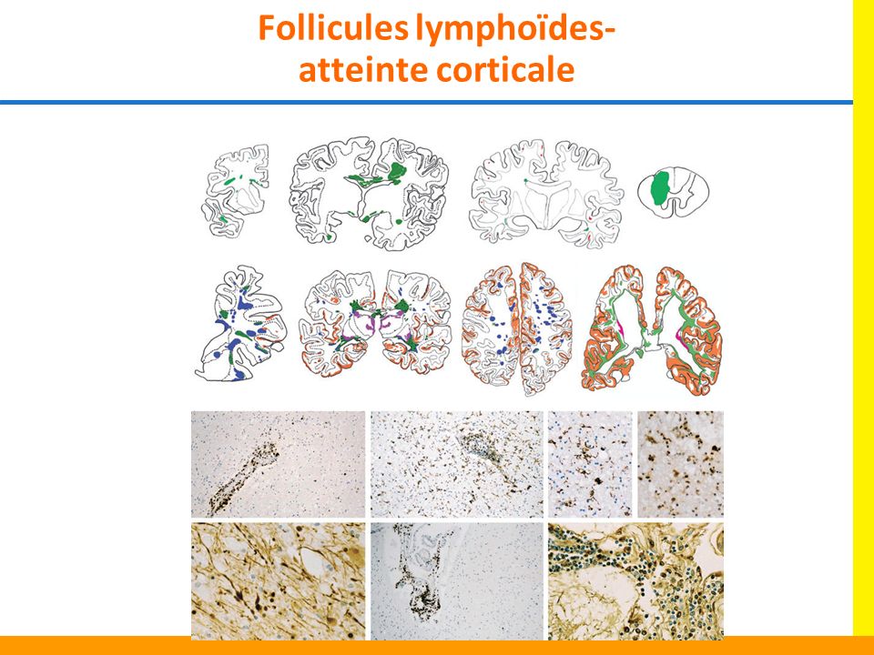 Follicules lymphoïdes- atteinte corticale