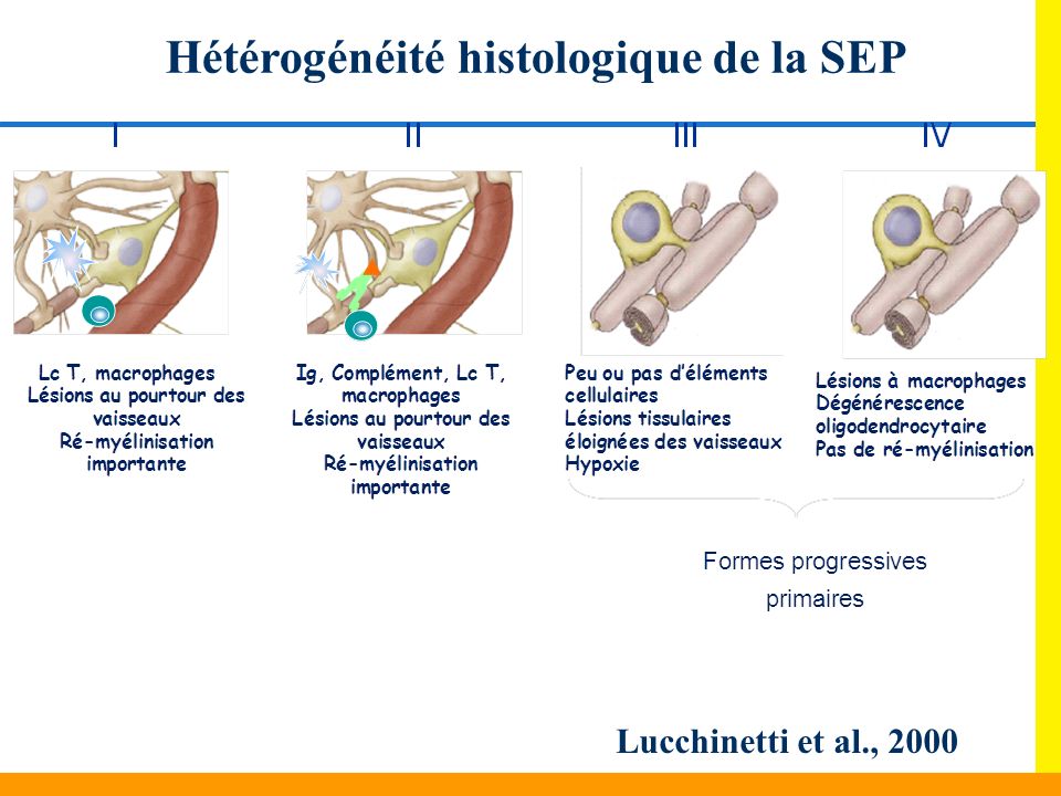 Hétérogénéité histologique de la SEP