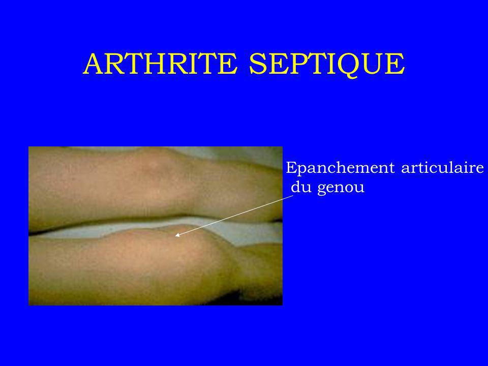 artrite septice)