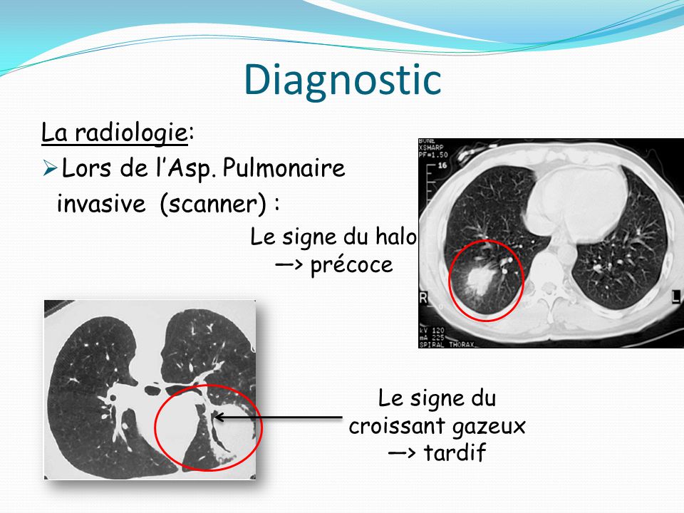 Aspergillus Et Aspergilloses Ppt Video Online Telecharger