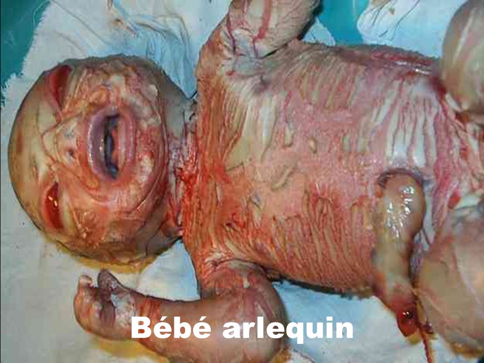 Pinakamabilis Syndrome Du Bebe Arlequin