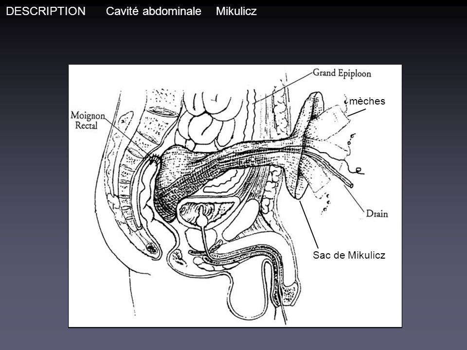 DESCRIPTION Cavité abdominale Mikulicz mèches vvvvv Sac de Mikulicz