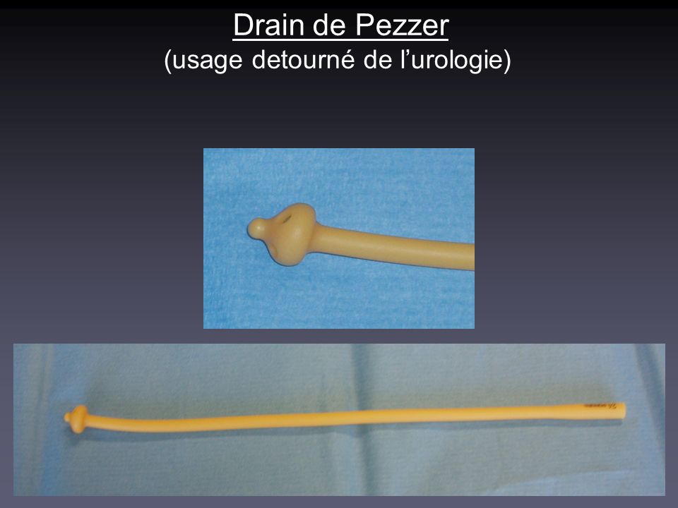 Drain de Pezzer (usage detourné de l’urologie)