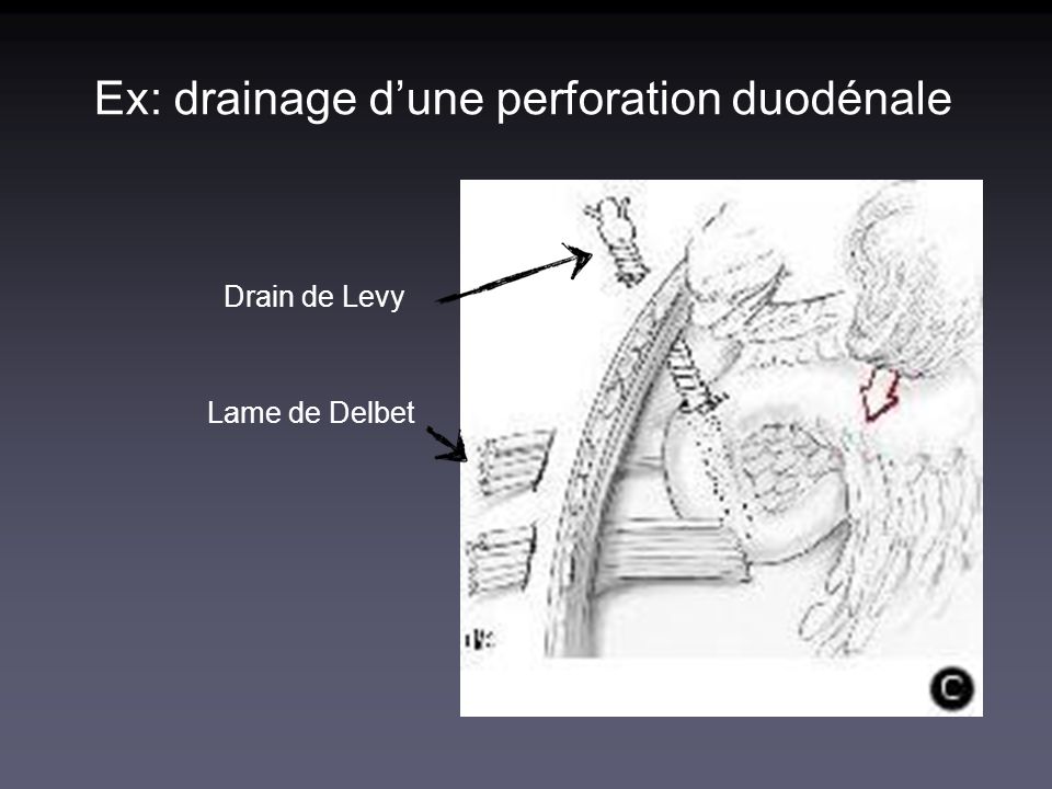 Ex: drainage d’une perforation duodénale