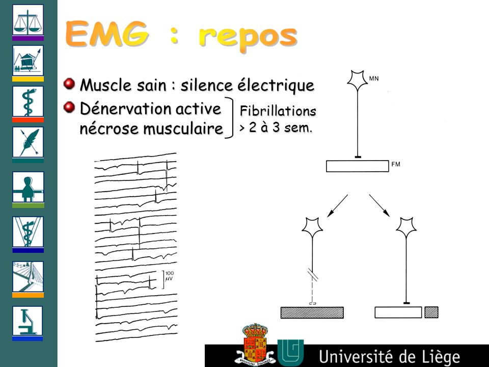 EMG : repos Muscle sain : silence électrique