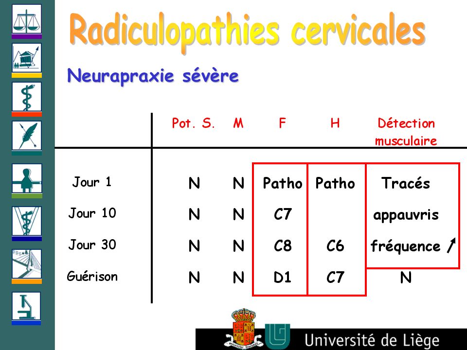 Radiculopathies cervicales
