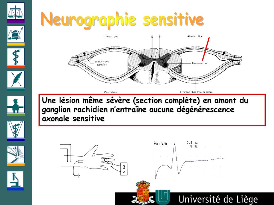 Neurographie sensitive