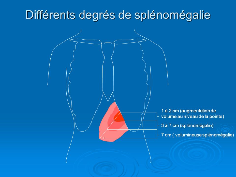 Différents degrés de splénomégalie