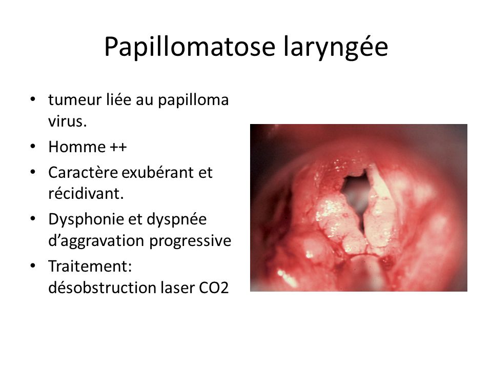 Papillomavirus laryngee