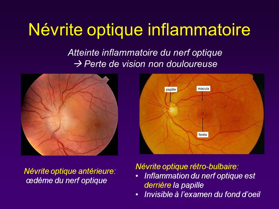 Aspect et imagerie du nerf optique - ppt video online télécharger