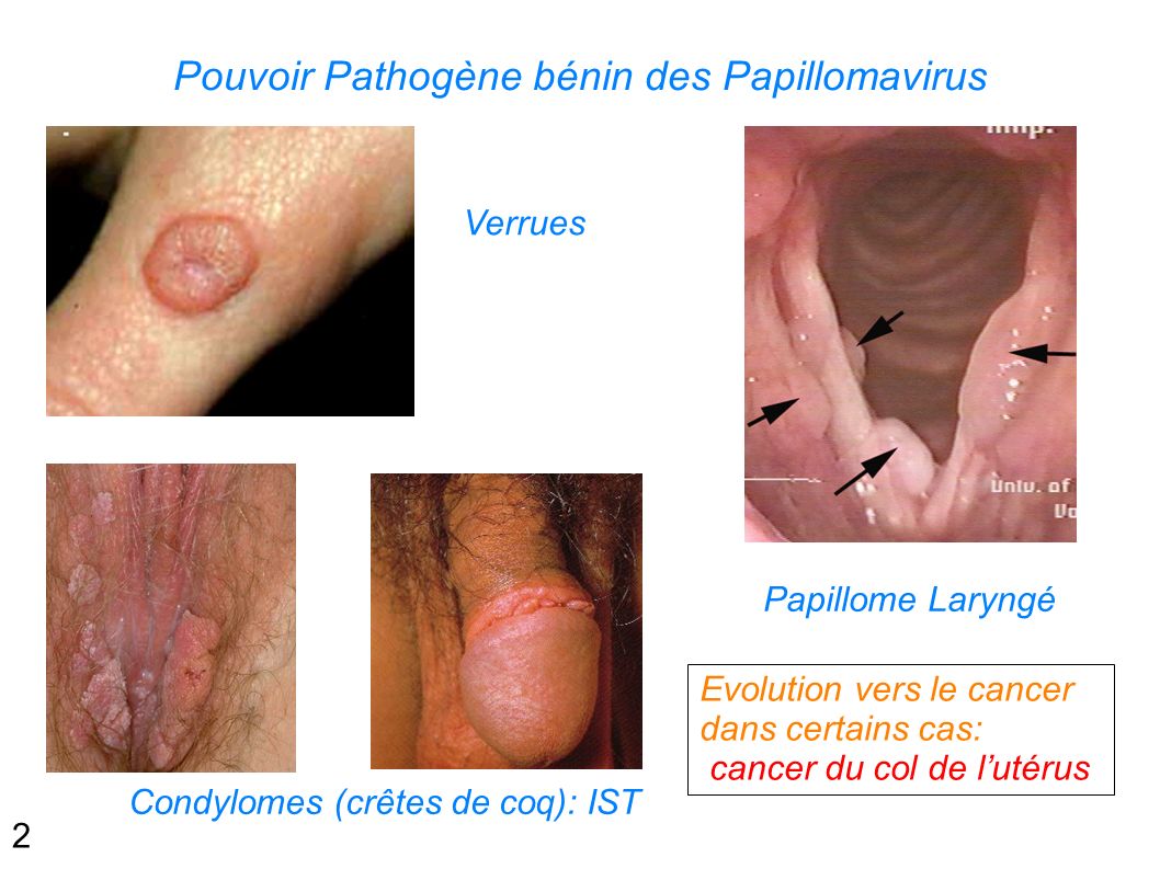 papillomavirus larynge)