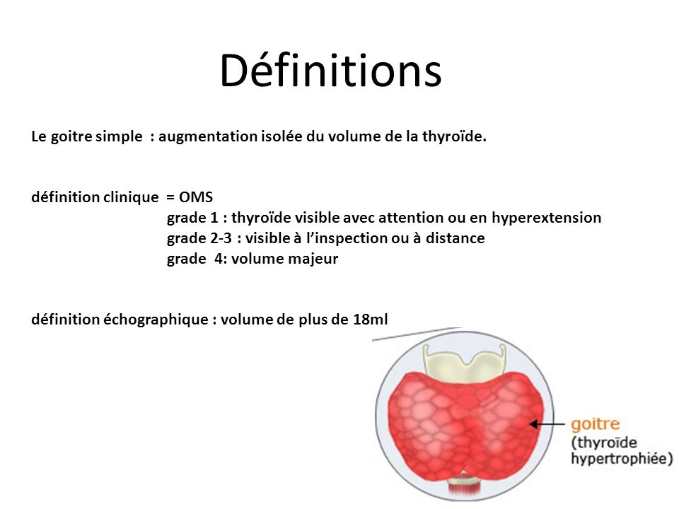 Définitions Le goitre simple : augmentation isolée du volume de la thyroïde. définition clinique = OMS.